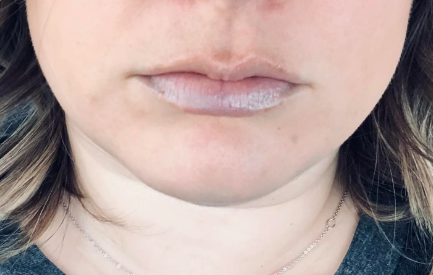 blauwe lippen stress symptomen