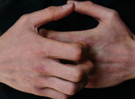 jeukende handen stress symptomen