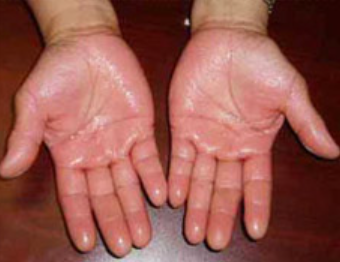 klamme handen en voeten symptomen