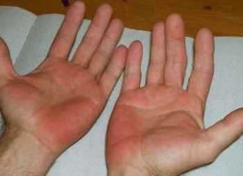 rode handpalmen door stress symptomen