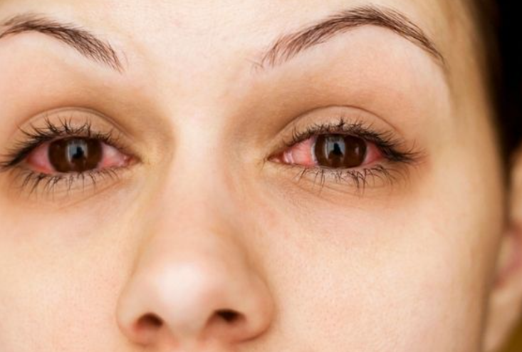 rode ogen door stress oorzaak