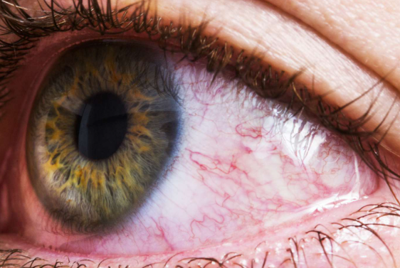 rode ogen stress symptomen